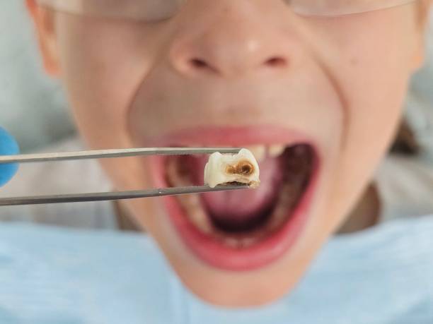 Best Emergency Tooth Extraction in Atkinson, IL